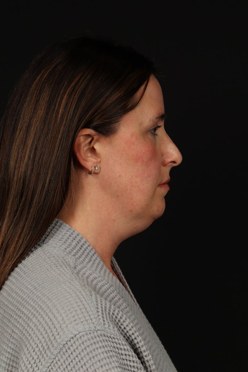 FaceTite Before & After Gallery - Patient 397122 - Image 9