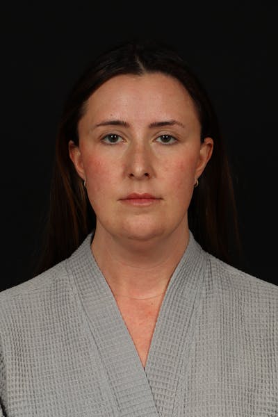 FaceTite Before & After Gallery - Patient 397122 - Image 1