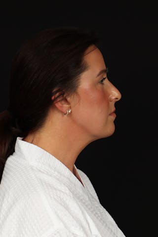 FaceTite Before & After Gallery - Patient 397122 - Image 10