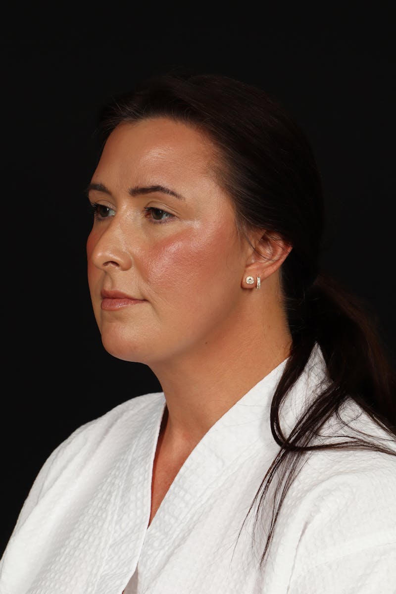 FaceTite Before & After Gallery - Patient 397122 - Image 4