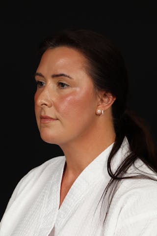 FaceTite Before & After Gallery - Patient 397122 - Image 4