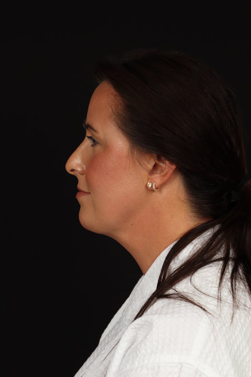 FaceTite Before & After Gallery - Patient 397122 - Image 6
