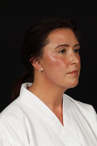 FaceTite Before & After Gallery - Patient 397122 - Image 8