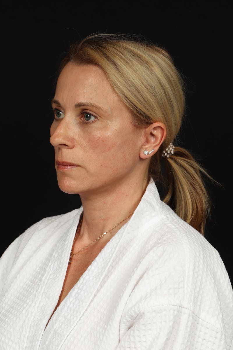 Facelift Before & After Gallery - Patient 374058 - Image 4