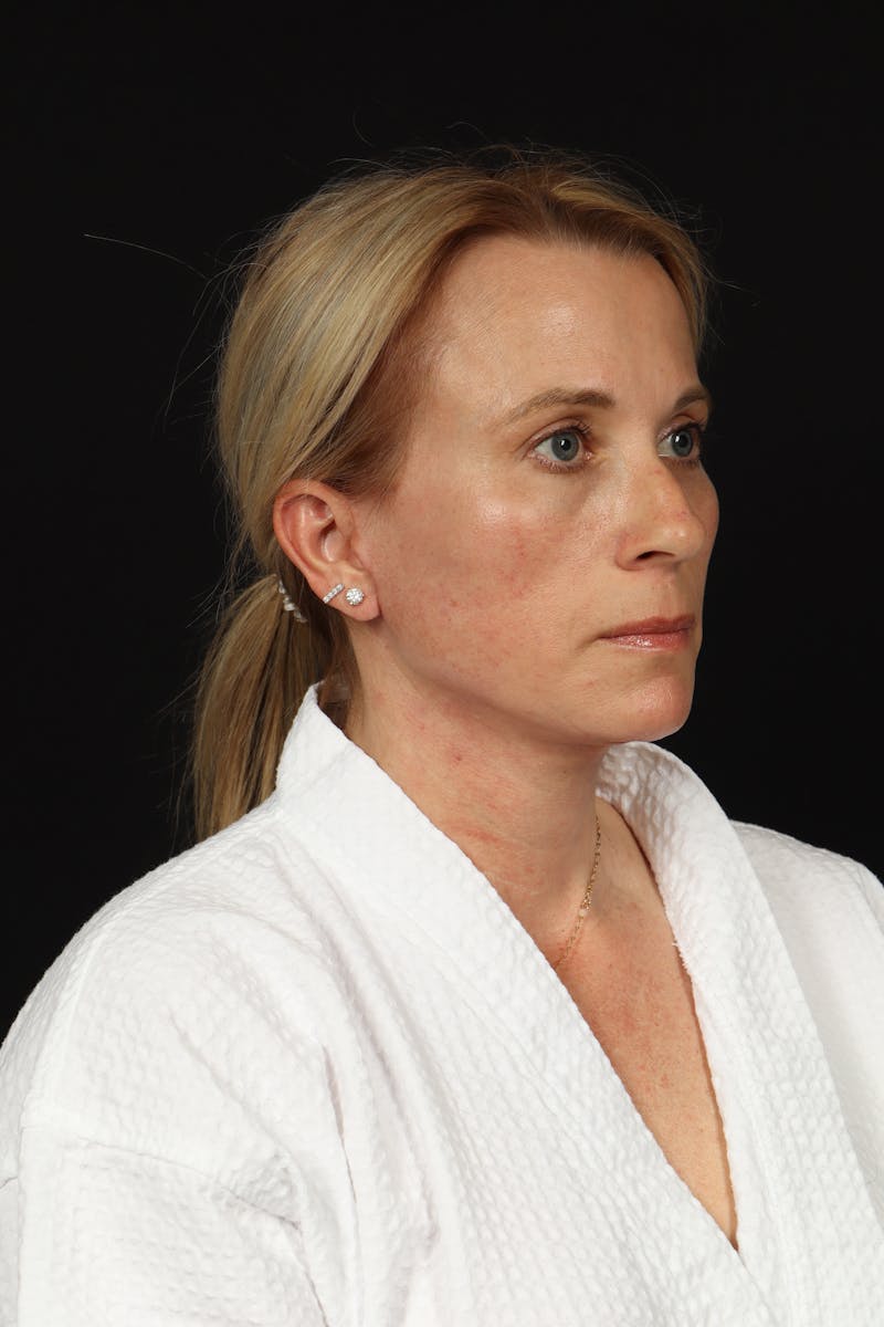 Facelift Before & After Gallery - Patient 374058 - Image 8
