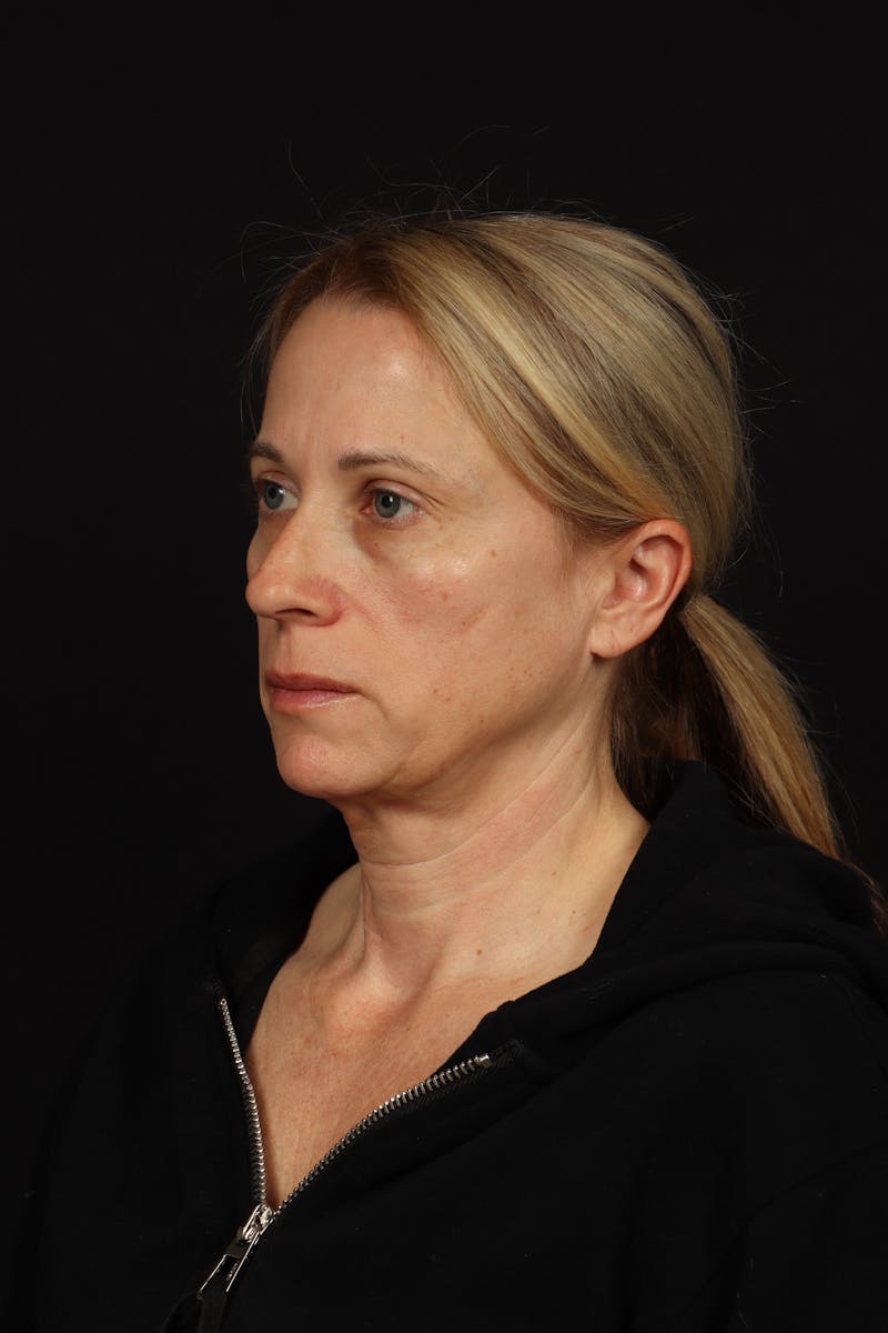 Facelift Before & After Gallery - Patient 374058 - Image 3