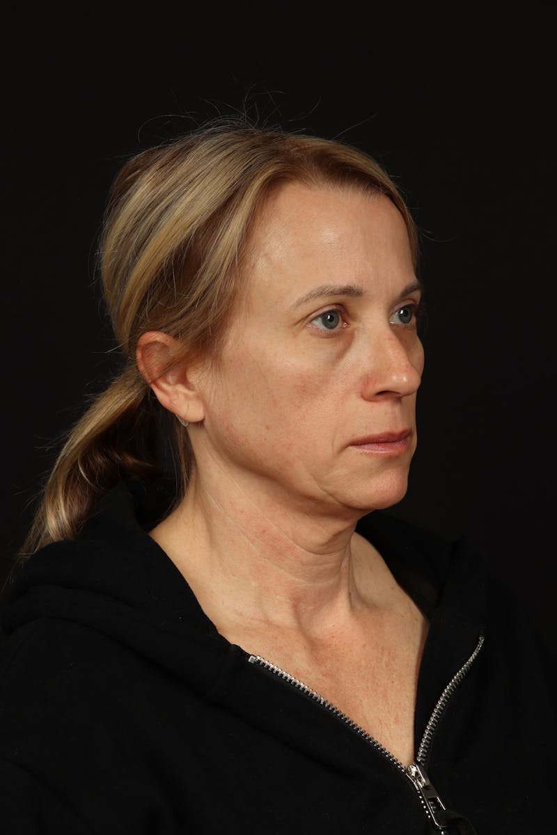 Facelift Before & After Gallery - Patient 374058 - Image 7