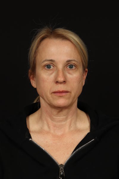 Facelift Before & After Gallery - Patient 374058 - Image 1
