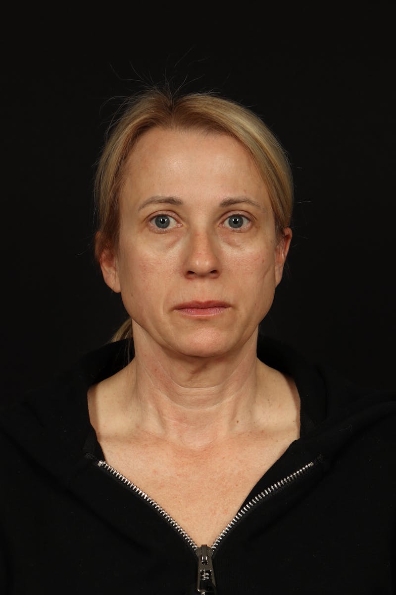 Facelift Before & After Gallery - Patient 374058 - Image 1