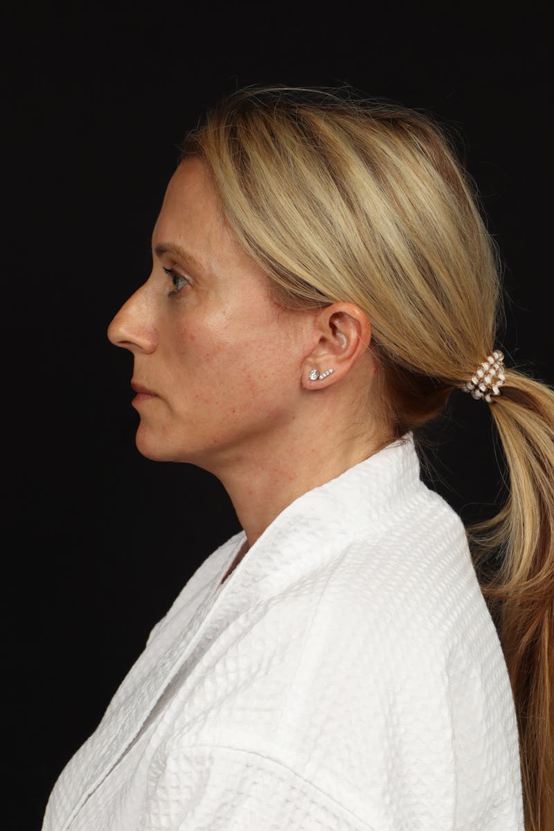 Facelift Before & After Gallery - Patient 374058 - Image 6