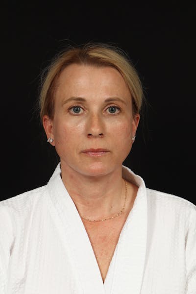 Facelift Before & After Gallery - Patient 374058 - Image 2