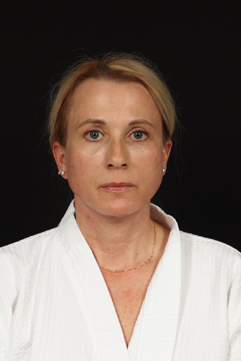 Facelift Before & After Gallery - Patient 374058 - Image 2