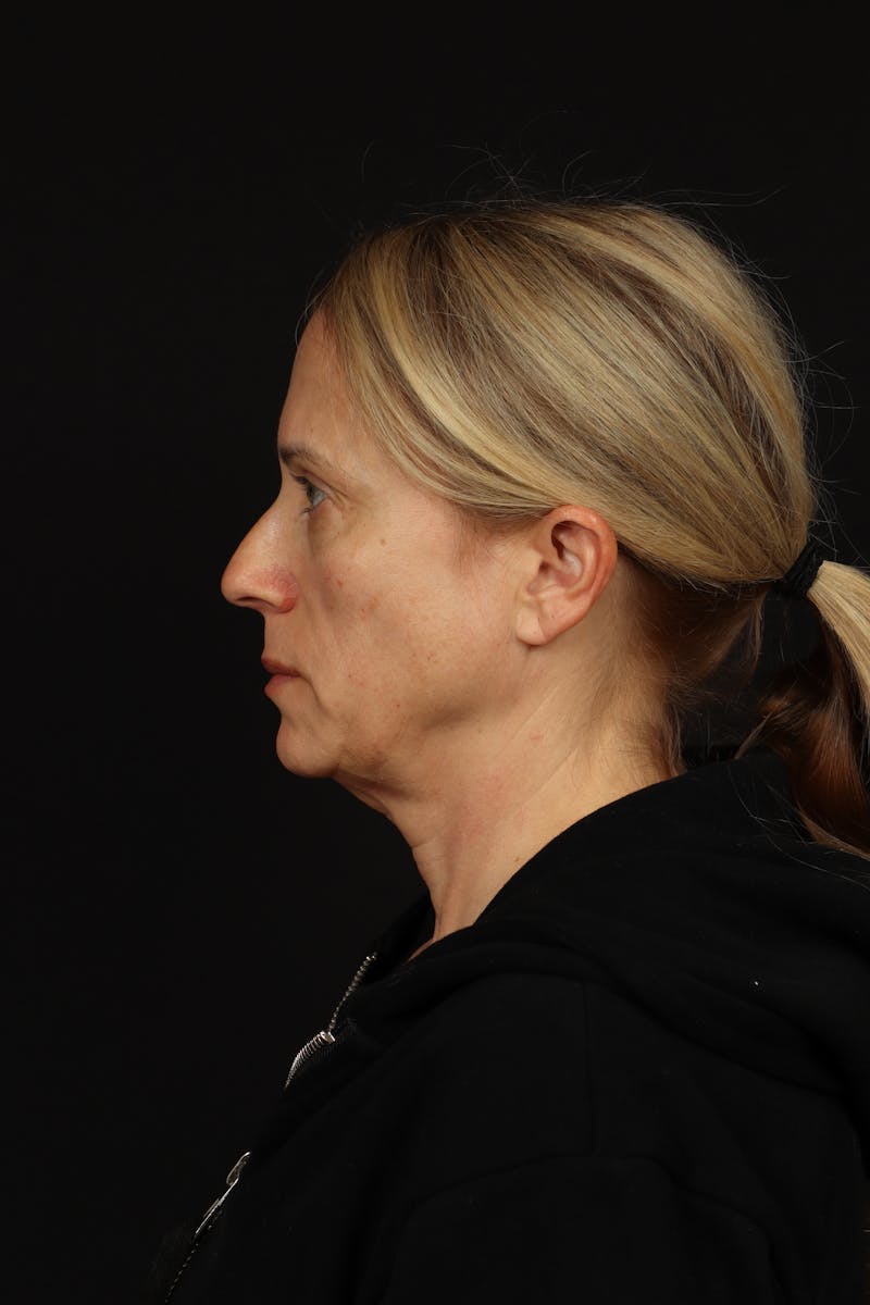 Facelift Before & After Gallery - Patient 374058 - Image 5