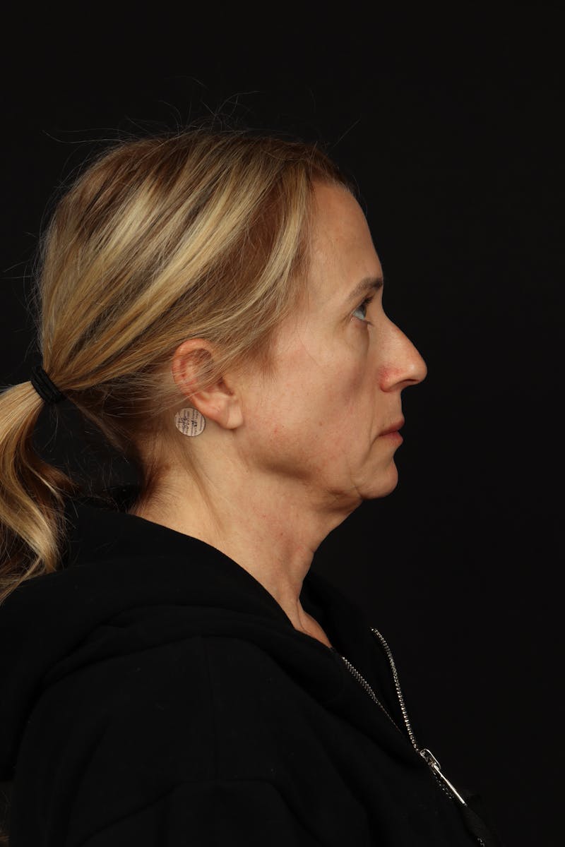 Facelift Before & After Gallery - Patient 374058 - Image 9