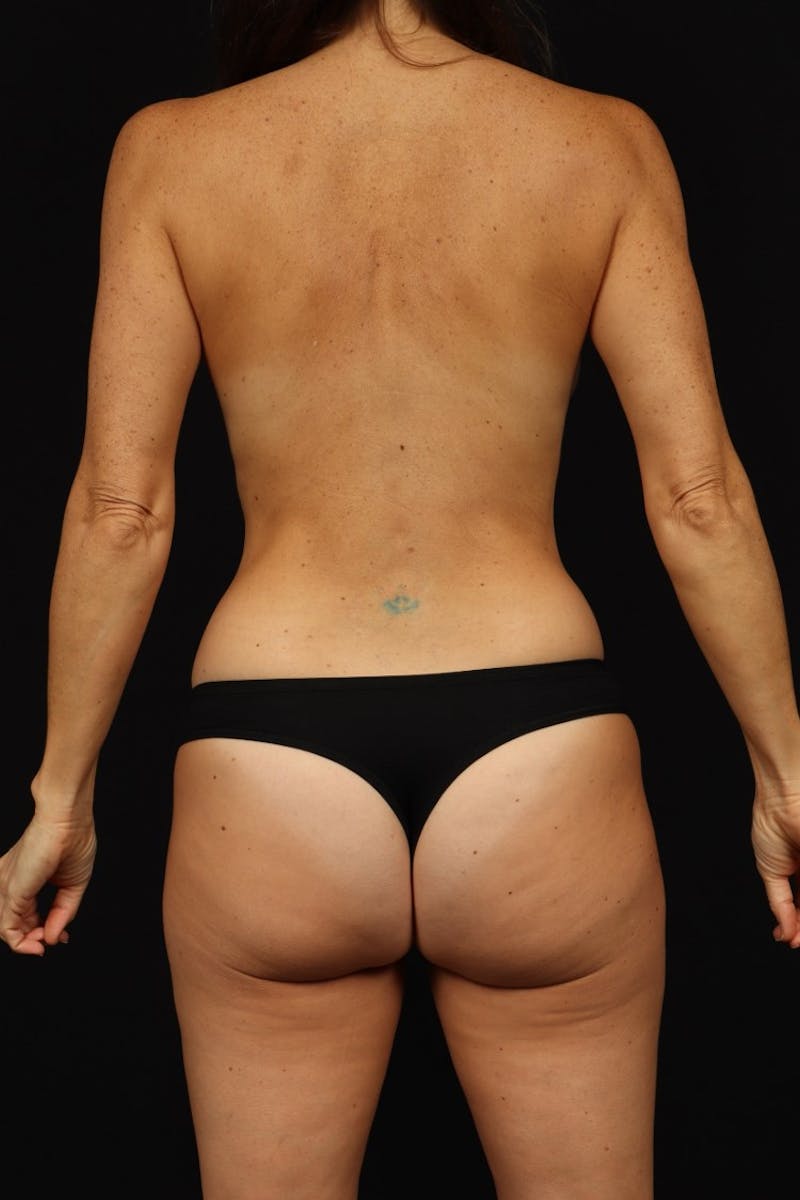 Abdominoplasty Before & After Gallery - Patient 744122 - Image 11