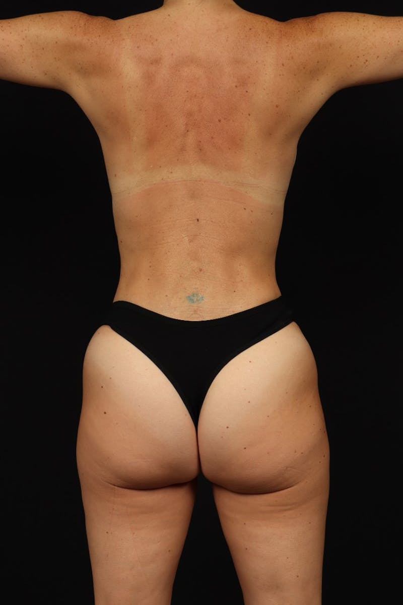 Abdominoplasty Before & After Gallery - Patient 744122 - Image 12