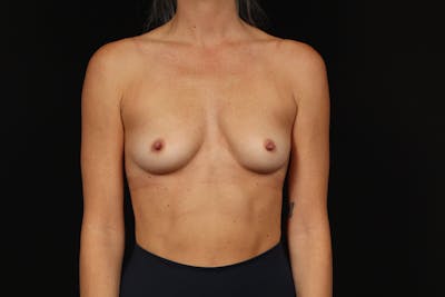 Breast Augmentation Silicone Gel Before & After Gallery - Patient 252521 - Image 1