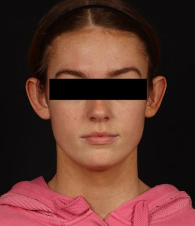 Otoplasty Before & After Gallery - Patient 600001 - Image 1
