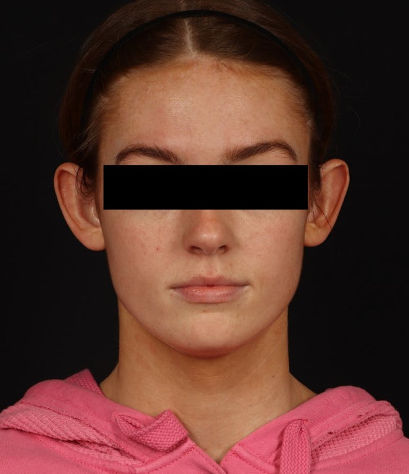 Otoplasty Before & After Gallery - Patient 600001 - Image 1