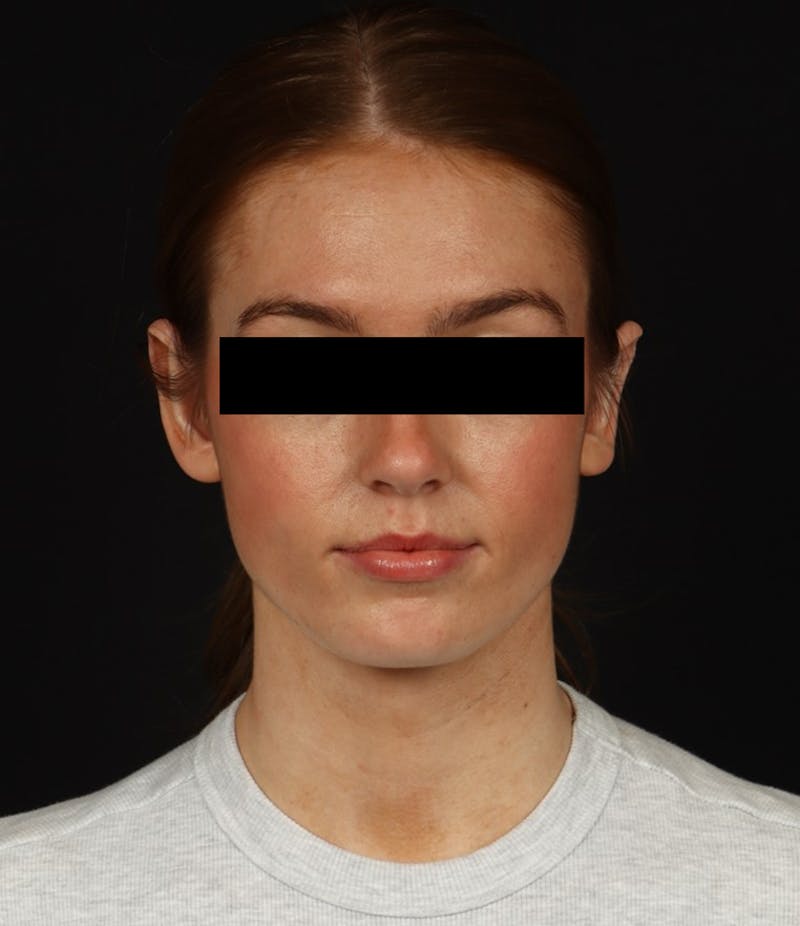 Otoplasty Before & After Gallery - Patient 600001 - Image 2