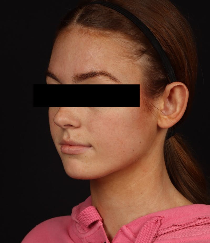 Otoplasty Before & After Gallery - Patient 600001 - Image 3