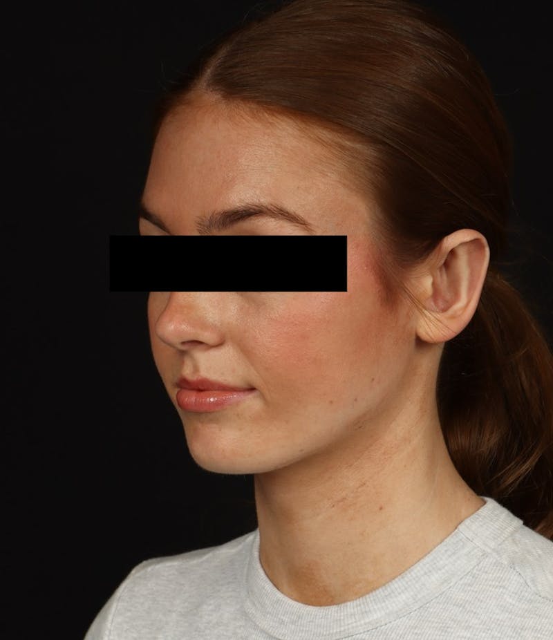 Otoplasty Before & After Gallery - Patient 600001 - Image 4