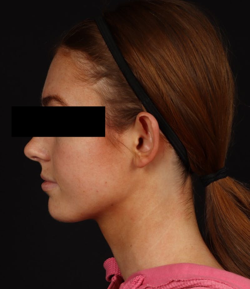 Otoplasty Before & After Gallery - Patient 600001 - Image 5