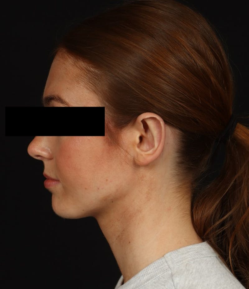 Otoplasty Before & After Gallery - Patient 600001 - Image 6
