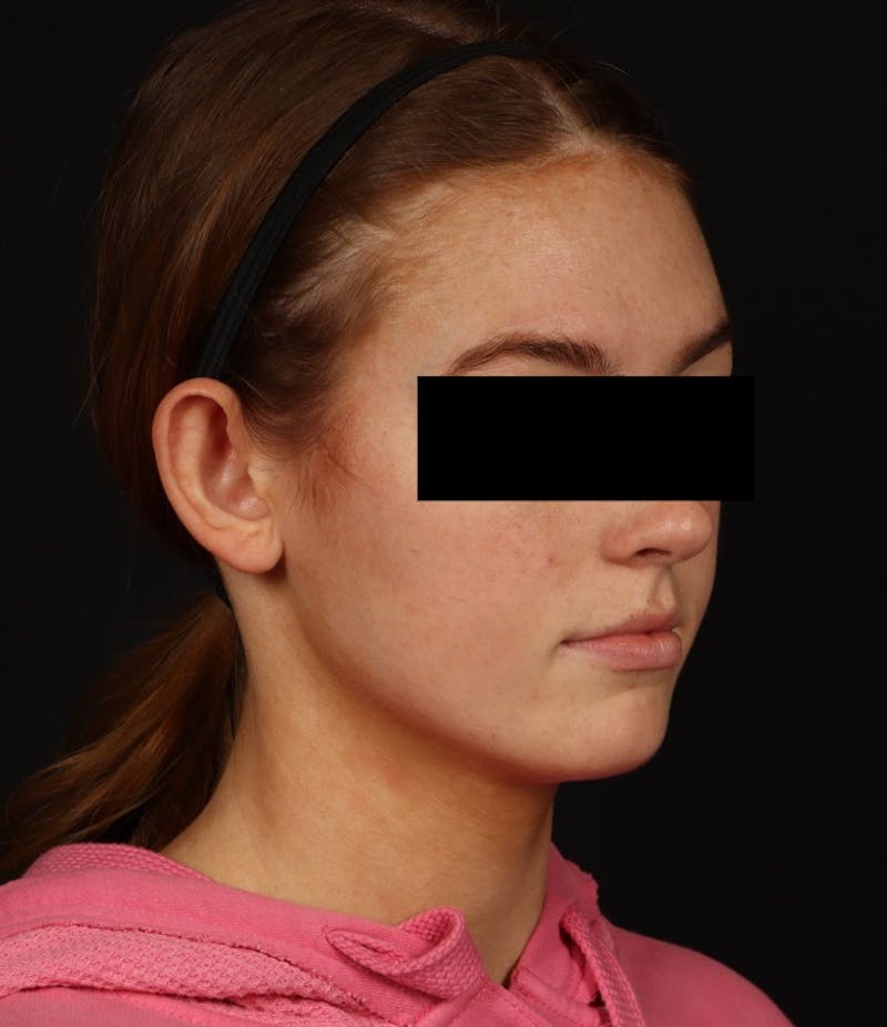 Otoplasty Before & After Gallery - Patient 600001 - Image 9