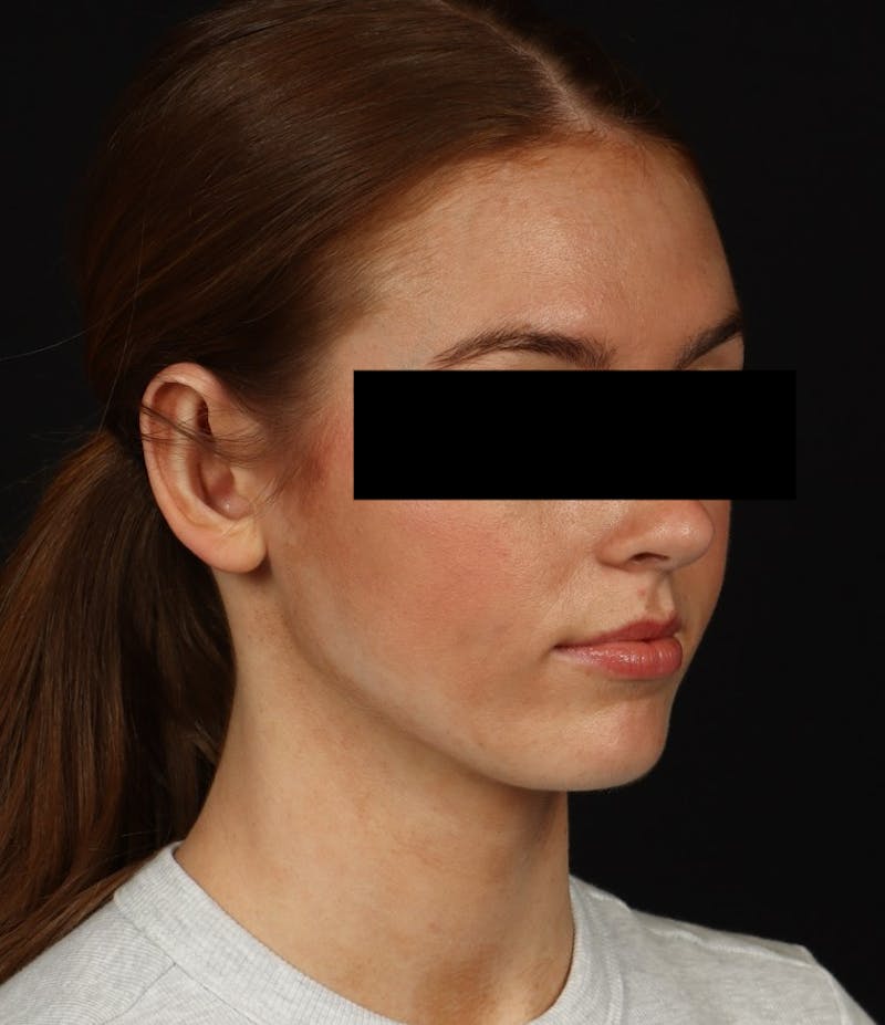 Otoplasty Before & After Gallery - Patient 600001 - Image 10