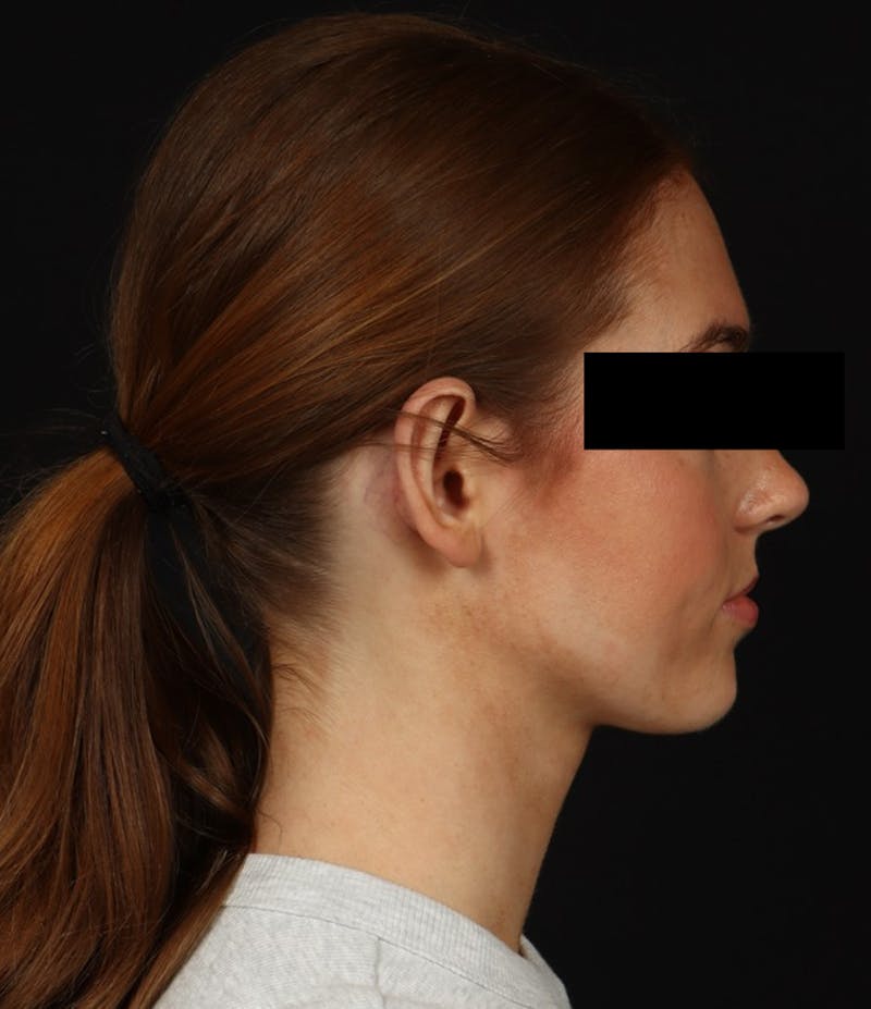 Otoplasty Before & After Gallery - Patient 600001 - Image 12