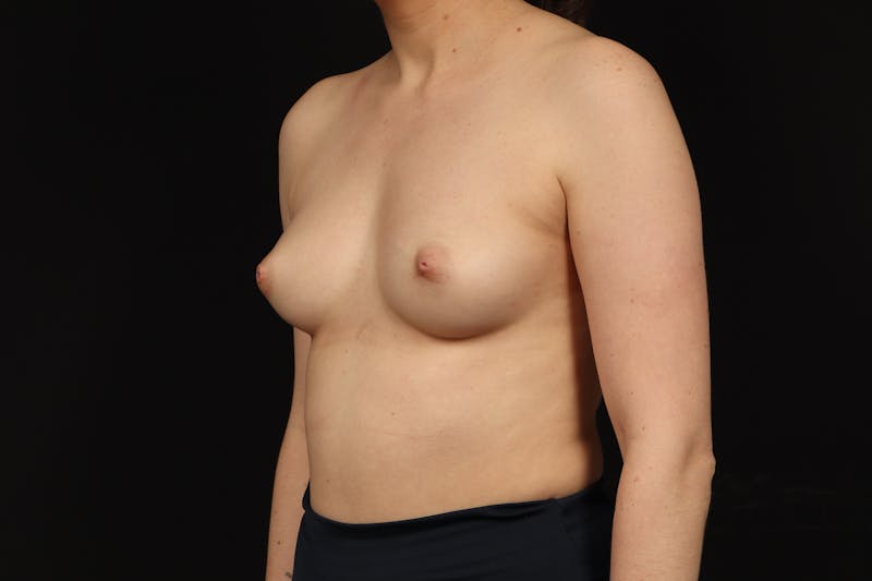 Breast Augmentation Silicone Gel Before & After Gallery - Patient 293565 - Image 3