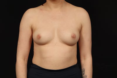 Breast Augmentation Silicone Gel Before & After Gallery - Patient 293565 - Image 1