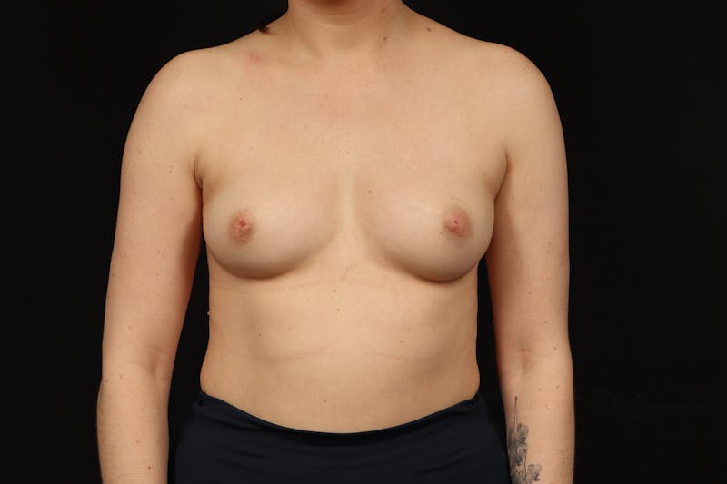 Breast Augmentation Silicone Gel Before & After Gallery - Patient 293565 - Image 1