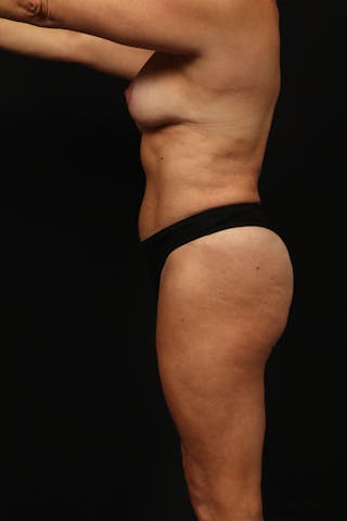 Mastopexy Before & After Gallery - Patient 806952 - Image 6