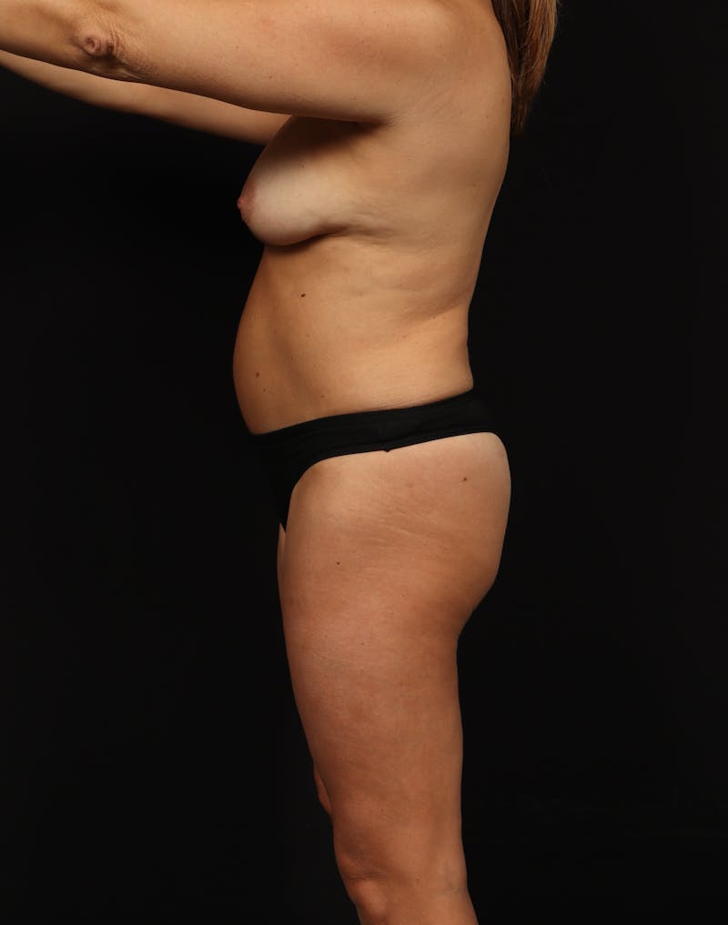 Mastopexy Before & After Gallery - Patient 806952 - Image 5