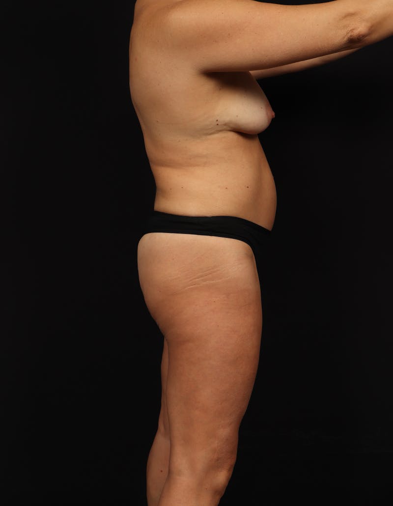 Mastopexy Before & After Gallery - Patient 806952 - Image 9