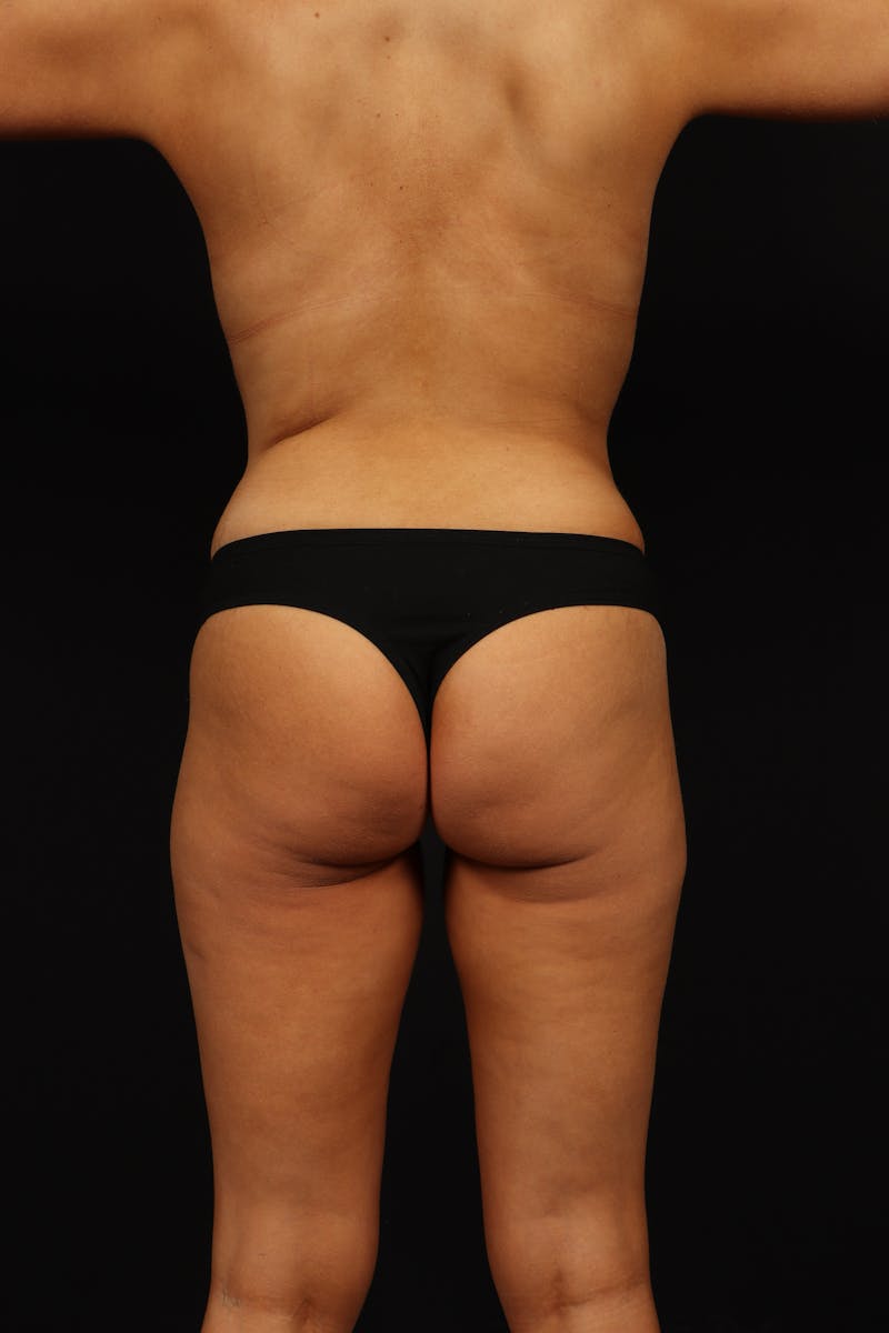Abdominoplasty Before & After Gallery - Patient 168770 - Image 7