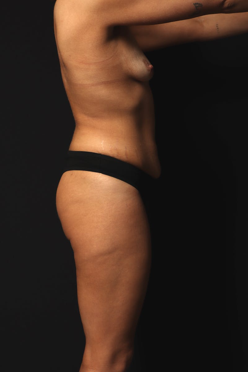 Abdominoplasty Before & After Gallery - Patient 168770 - Image 11