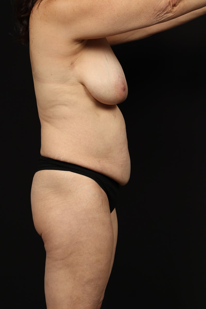Abdominoplasty Before & After Gallery - Patient 426706 - Image 11
