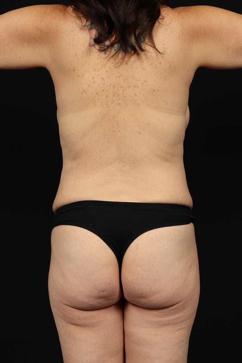 Abdominoplasty Before & After Gallery - Patient 426706 - Image 7