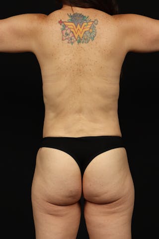 Abdominoplasty Before & After Gallery - Patient 426706 - Image 8