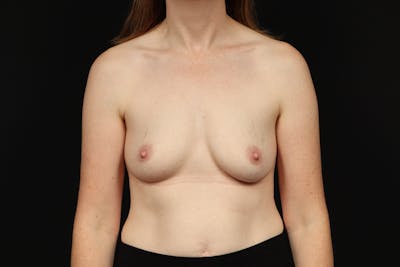 Breast Augmentation Silicone Gel Before & After Gallery - Patient 315294 - Image 1