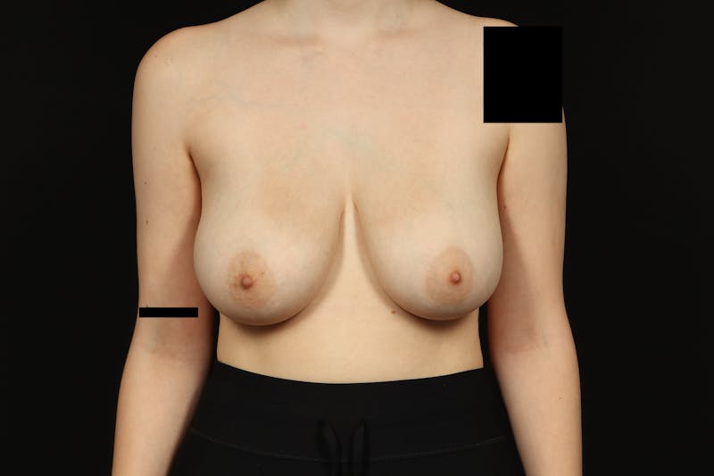 Breast Reduction Before & After Gallery - Patient 100455 - Image 1