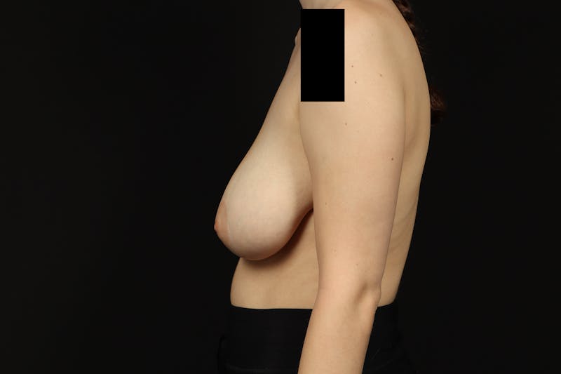 Breast Reduction Before & After Gallery - Patient 100455 - Image 5