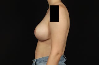 Breast Reduction Before & After Gallery - Patient 100455 - Image 6