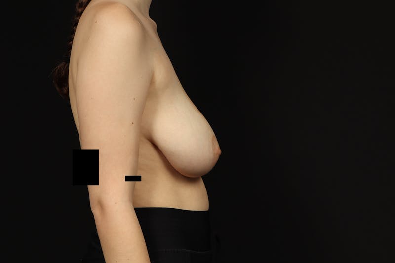 Breast Reduction Before & After Gallery - Patient 100455 - Image 9
