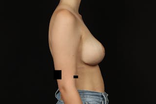 Breast Reduction Before & After Gallery - Patient 100455 - Image 10