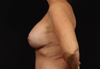 Aesthetic Breast Revision Before & After Gallery - Patient 254542 - Image 6
