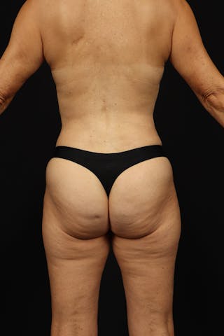 Mastopexy Before & After Gallery - Patient 780616 - Image 8